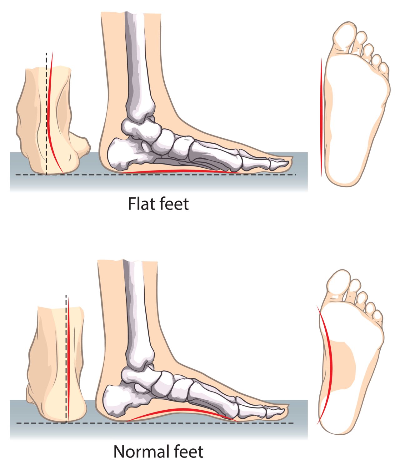 Normal neutral healthy foot compare with flat foot or fallen arch problem  with Foot print to show how entire sole of the foot to touch the floor when  stand up. Stock Photo