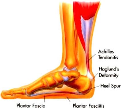 heel bone problems
